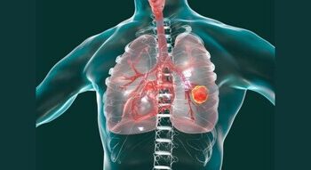 克服標靶藥副作用挑戰，平衡肺癌治療與生活品質