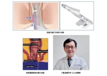 微創痔瘡治療有三寶 免住院傷口小疼痛少