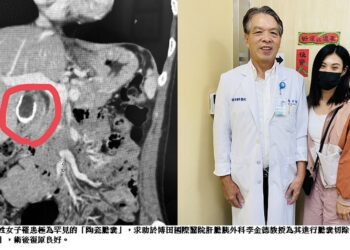 膽囊鈣化成石 罕見陶瓷膽囊現身！
