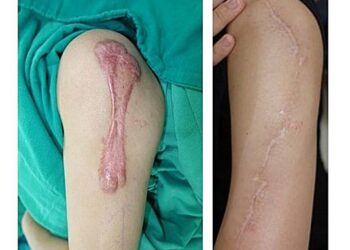 「蟹足腫」困擾近20年　專業醫療有解方