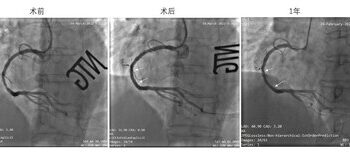 先健科技IBS®可吸收藥物洗脫冠脈支架系統完成III期臨床研究入組